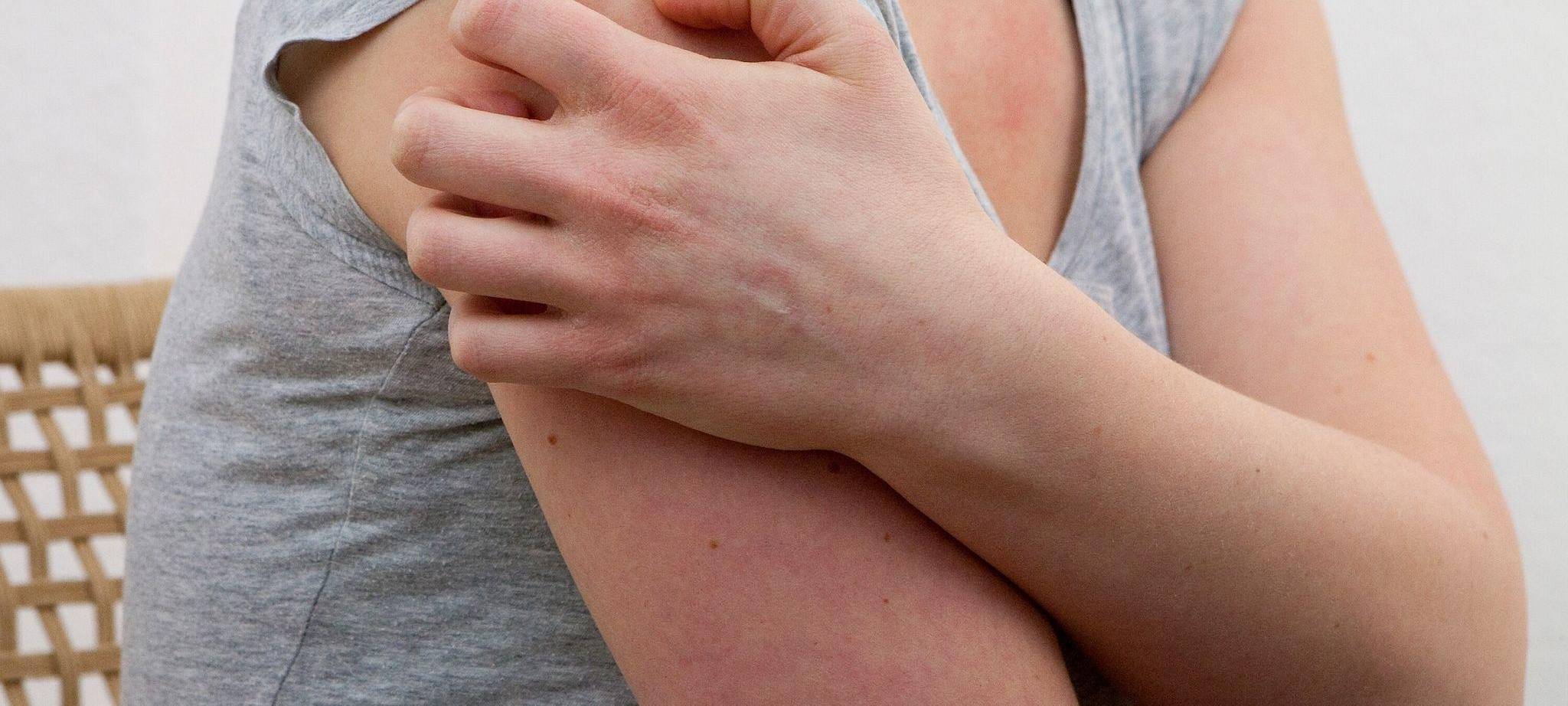 Eine Frau kratz sich am Oberarm